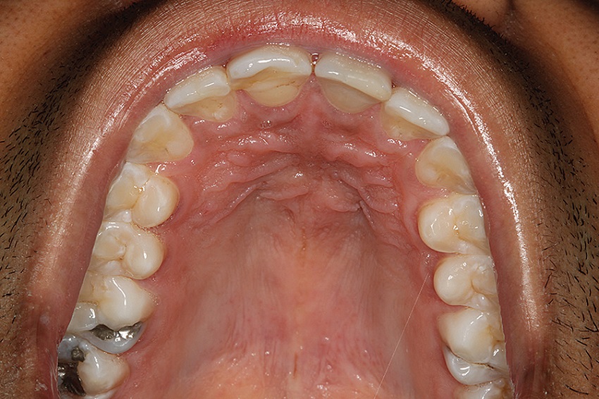 Intraoral aspect of the patient of case 2, 30 months after
							surgery