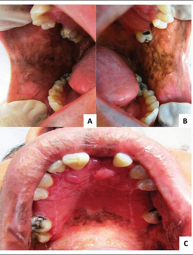 Intraoral manifestations of LHS