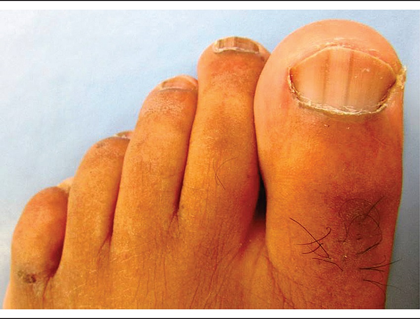 Longitudinal brownish bands in patient's toenails