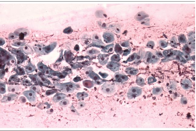 Atrophic vaginitis (atrophy with inflammation) cytology of a 71 year
							old patient. Immature (parabasal) cells and polymorphonuclear leukocytes
							are present in a granular inflammatory exudate background that resembles
							tumor diathesis (Papanicolaou, 400&times;)