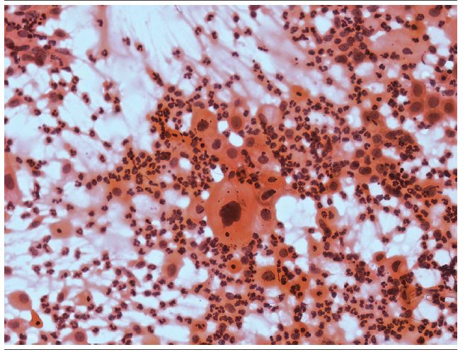 Dyskaryotic smear cytology of a 67-year-old patient Squamous cells
							present in an atrophic smear. Presence of polymorphonuclear leukocytes
							in the slide background with granular material that resembles tumor
							diathesis (Papanicolaou, 400&times;).
