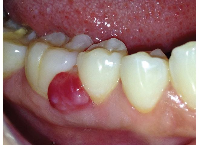 Reddish, sessile mass in the right vestibular mandibular gingiva
							between the second premolar and the first molar