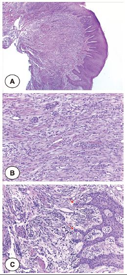 Lesion covered by hyperplastic squamous epithelium, exhibiting foci
							of hydropic degeneration, spongiosis, and exocytosis (A) - HE, original
							magnification 40&times;. Cellular fibroblastic connective tissue with
							numerous islands and strands of odontogenic epithelium, intermingled
							with a mild mononuclear inflammatory infiltrate (B) - HE, original
							magnification 100&times;. Detail of the budding (red arrows) from the
							basal layer of the surface epithelium (C) - HE, original magnification
							200&times; 