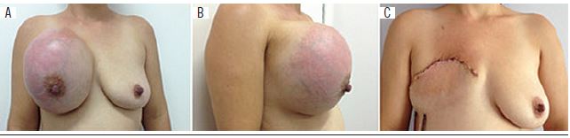 Physical examination, inspection: A) frontal photograph of the
								patient, with a mass occupying almost the whole right breast
								parenchyma, associated with cutaneous hyperemia and visualization of
								the superficial vascular network; B) photograph in profile, with
								observation of bulging in the upper right breast pole; C) frontal
								photograph, on the second postoperative day