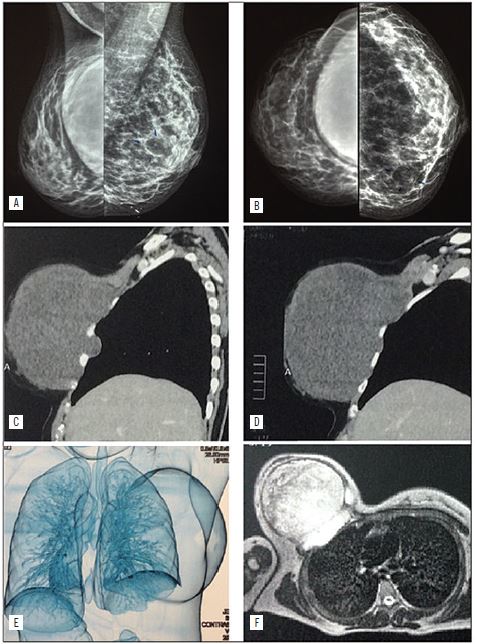 Complementary tests: A) and B) mammography, with a large,
								circumscribed and well defined nodular volume, located in an
								apparent right retro pectoral topography; C), D) and E) computed
								tomography of the chest, showing expansion formation in the mammary
								region on the right, signs of extension to the chest wall, but
								without apparent bone invasion; F) nuclear magnetic resonance of the
								thorax, observing a heterogeneous solid lesion located in a retro
								pectoral region on the right, measuring 16 &times; 14.8 cm, with no
								apparent lesions in the mediastinum or pulmonary parenchyma