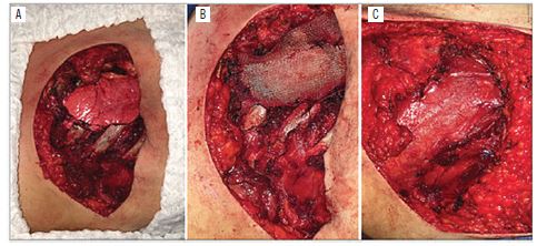 Intraoperative view: A) surgical field after complete resection
								of the lesion. A typical pulmonary parenchyma is observed; B)
								closure of the thoracic wall with the help of a Marlex mesh; C) full
								coverage of the mesh, using the apical segment of the pectoralis
								major muscle