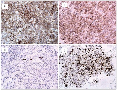 Immunohistochemistry: A) positive expression of CD99 marker; B)
								positive expression of CD56 marker; C) positive expression of CD57
								marker; D) Ki-67 marker expression in 70% of tumor cells
