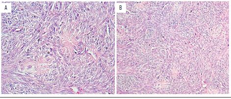 Differential diagnosis of ES/primitive neuroectodermal tumor.
								Microphotographs of the described case, with observation of spindle
								cells exhibiting pattern in rosettes and cells arranged in bundles,
								with storiform aspect 