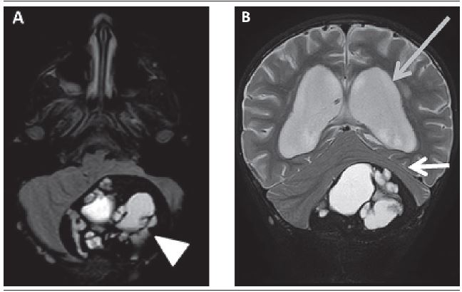 A) MRI in the FLAIR sequence in the axial section demonstrating
							well-defined extra-axial mass in the posterior fossa to the left,
							traversing the occipital bone posteriorly, projecting to adjacent soft
							parts with extensive internal hemorrhage (arrowhead), pressing the
							cerebellar hemispheres; B) MRI in the T2 SPIR sequence in the coronal
							section demonstrating well-defined extra-axial mass in the posterior
							fossa to the left, projecting to adjacent soft parts with extensive
							internal hemorrhage, pressing the cerebellar hemispheres (thin white
							arrow) and distorting the fourth ventricle with severe upstream
							hydrocephalus (gray arrow)