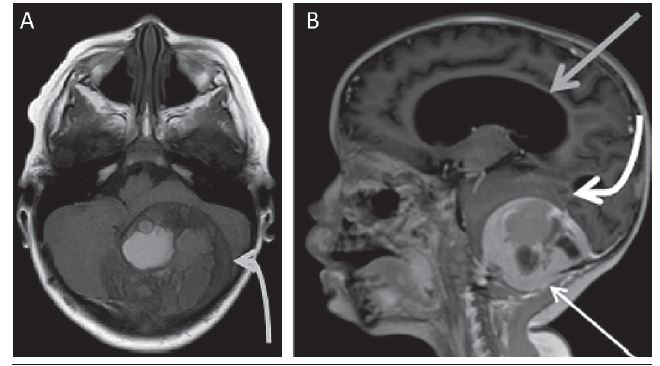 A) MRI in T1-weighted axial image without contrast demonstrating
							well-defined extra-axial mass in the posterior fossa (curved light gray
							arrow), projecting to the adjacent soft parts; B) MRI, T1-weighted
							post-contrast sagittal image demonstrating well-defined extra-axial mass
							in the posterior fossa traversing the posterolateral inferior occipital
							bone, projecting to the adjacent soft parts, with intense peripheral
							enhancement by contrast (fine white arrow), striking the cerebellar
							hemispheres (curved arrow) and distorting the fourth ventricle with
							severe hydrocephalus upstream (gray arrow)