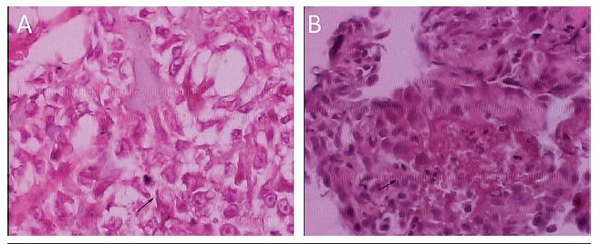 A) photomicrography HE 400&times;: presence of nests of epithelioid
							osteoblasts, nucleoli and cellular atypia (black arrow); B)
							photomicrography HE 400&times;: microcystification with hemorrhage
							(black arrow)
