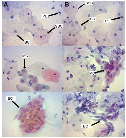 Photomicrographs of cell types observed in cervical specimens by Pap
smear (A) and preserved in FIPLIQ after 15 days (B). Papanicolaou stain,
400×