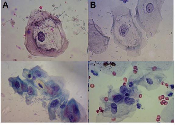Cytological abnormalities in cervical cells by Pap smear (A) and
preserved in FIPLIQ after 15 days. Papanicolaou stain,
400×
