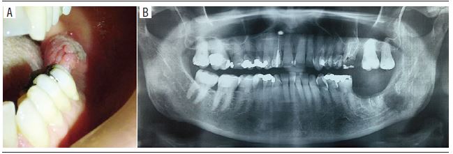 A) exophytic mass located at the left mandibular gingiva. Previous
dental extraction and chronic suppurative osteomyelitis were noticed in
this area; B) panoramic radiograph showing an osteolytic area with
irregular and ill-defined borders