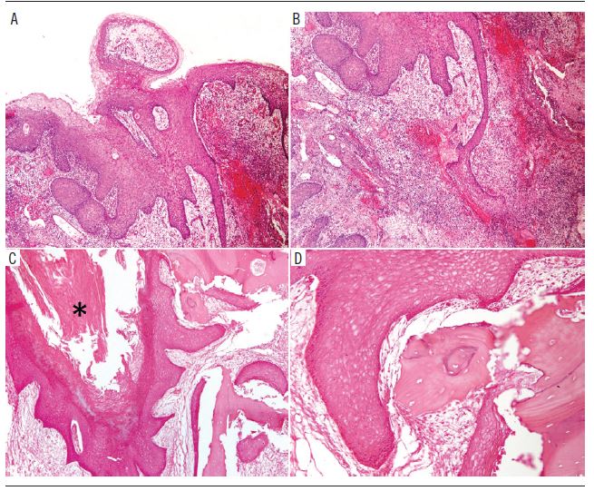 The microscopic analysis showed intense well-differentiated squamous
epithelial proliferation, with frequent invaginations (A, 5×).
The fibrovascular stroma showed numerous inflammatory cells (B,
5×). Notice the large area of keratin deposition (asterisk), foci
of osseous resorption in close relationship with florid squamous
epithelial proliferation with prominent invagination (C, 5× and
D, 20×). Hematoxylin and eosin stain