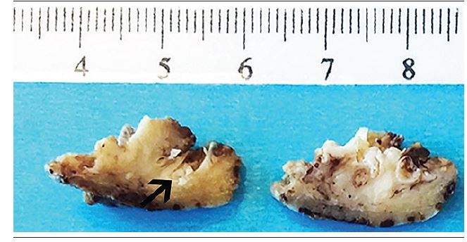 Macroscopic view of the surgical specimen showing several white
areas, which correspond to keratin formation, reaching the basal portion
of the mandible. The arrow shows the typical "rabbit burrow", which by
microscopy showed similar histopathological features to those in Figure 2C (asterisk)