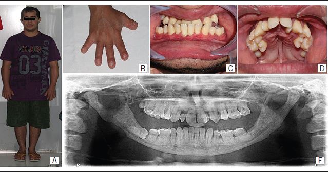 Extraoral and intraoral clinical features of patient case
                                1