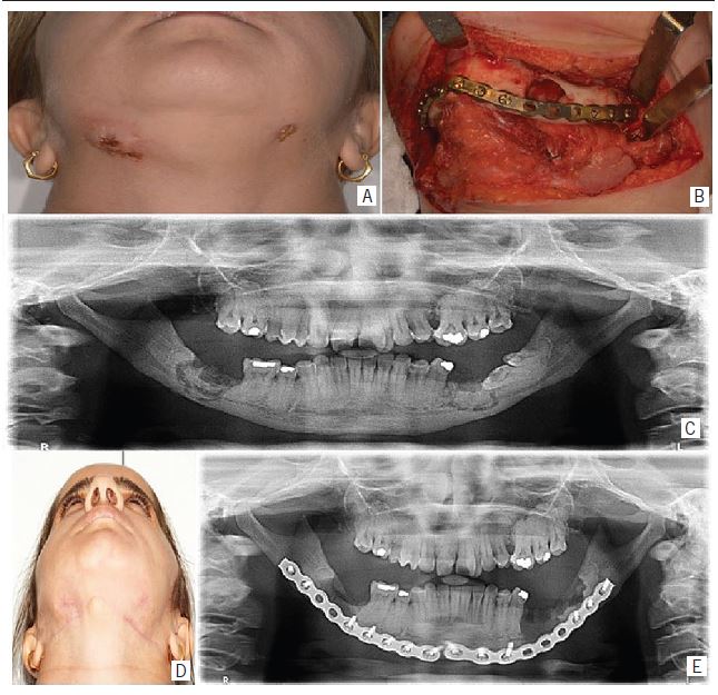 Treatment of osteomyelitis in patient of case 2 A) bilateral
                                extraoral bone sequestration in the mandible body; B) perioperative
                                sequestrectomy and plaque fixation to prevent fracture; C) panoramic
                                radiograph evidencing the presence of bone sequestration arising
                                from osteomyelitis, and obtuse mandibular angle; D) two years of
                                follow up with extraoral healing; E) panoramic radiograph showing
                                osseointegration.