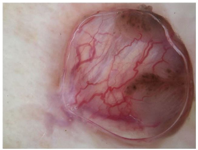 Lesion in dermoscopy