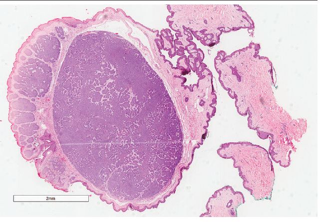 Polypoid BCC: histopathology (HE, 12&times;)