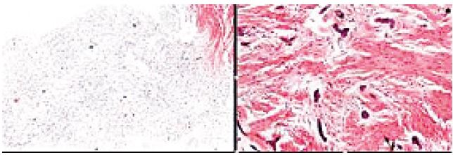 Histopathological examination showing a mucosa covered by the
                            parakeratinized stratified squamous epithelium, dense connective tissue
                            with zones of proliferation of spindle and oval cells amid deposition of
                            mineralized trabeculae (10&times; magnification)