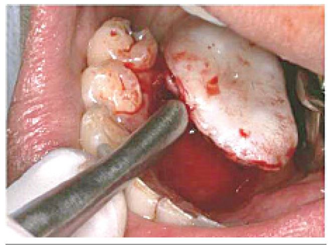 Intraoral image showing the lesion