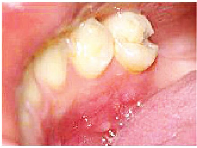 Postoperative (two months)