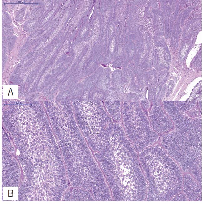 A) multiple nests and strands of odontogenic epithelium demonstrating
                            peripheral columnar differentiation with reverse polarization. Central
                            zones resemble stellate reticulum (HE, 500 &micro;m); B) higher
                            magnification highlights the peripheral columnar cells exhibiting
                            reverse polarization (HE, 100 &micro;m)