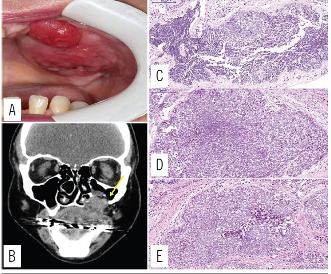 A) preoperative clinical view of last recurrence of lesion; B) CT
                            image that shows a hypodense image with extensive rupture of cortical
                            bone and invasion of maxillary sinus (yellow arrow); C) fragments of
                            malignant neoplasm of odontogenic epithelial origin, showing cellular
                            atypia and pleomorphism, nuclear hyperchromatism, cystic degeneration
                            foci and necrosis (HE, 500 &micro;m); D) focal areas of desmoplasia
                            (HE, 100 &micro;m)