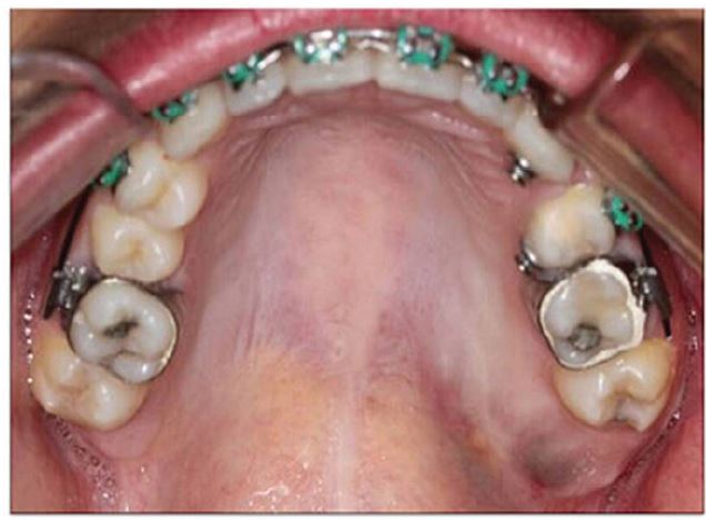 Intra-oral examination: expansive lesion in left posterior
                            palate