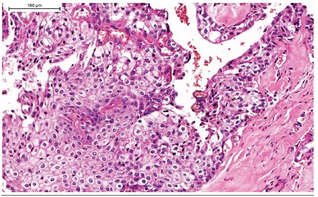 Histological examination of the specimen revealed a neoplasm composed
                            predominantly of nests of epidermoid cells with intermediate
                            differentiation in a fibrous stroma