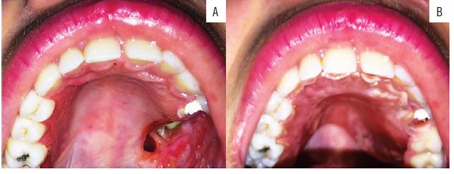 The patient is under clinical and radiographic follow-up and has been
                            disease free for two years