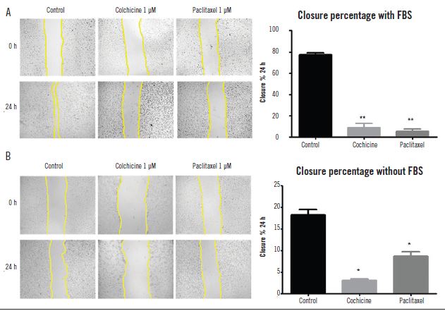 In vitro closure of the wound healing assay area after 24 hours colchicine or paclitaxel treatment in the presence or absence of serum U87MG cells were plated at 1.5 × 105 cells/well and treated for 24 hours with 1 μM colchicine or 1 μM paclitaxel diluted in DMEN/F12 with (A) or with no (B) serum. Images were captured by a camera coupled to the Bel view inv 100 microscope, with 40× magnification, before treatment (time-0) and after 24 hours of the treatment, and compared with the negative control with no drugs. The images were analyzed using the Image J software to evaluate the scratch by quantification of the areas occupied by the lesion. The graph shows the average values and the standard error of three experiments in quadruplicates. Test Anova followed by Dunnett post-hoc test; ***p < 0.001.