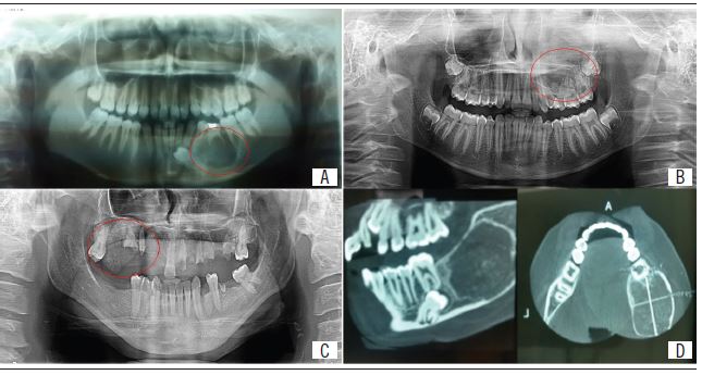 Radiographic aspects A) well-circumscribed radiolucent image in the mandible; B) osteolytic image with radiopaque foci in the maxilla; C) image with radiopaque foci in the maxilla; D) radiolucent image with radiopaque foci in the mandible.