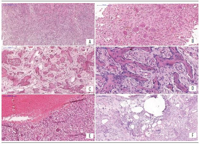 Histopathological aspects A) hypercellularity in JOF; B) presence of multinucleated giant cells; C) psammomatoid pattern; D) osteoid deposition by mesenchymal cells and forming trabecular pattern; E) presence of hemorrhagic areas; F) pseudocystic degeneration present in case 1.
