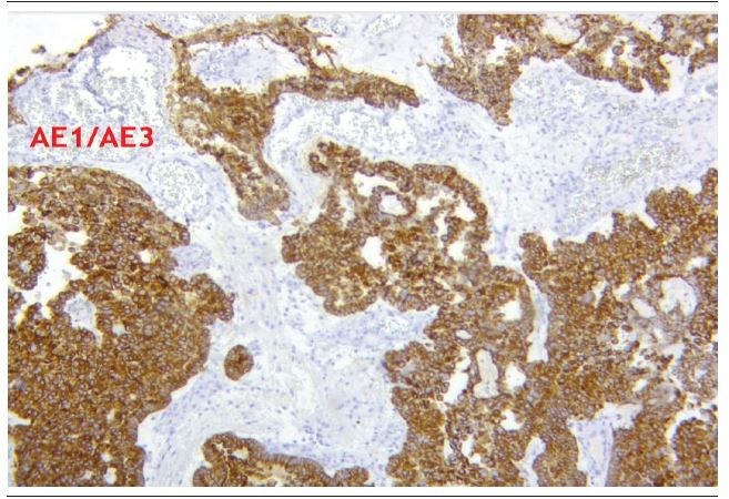 Immunohistochemistry demonstrating negative cells for AE1/AE3