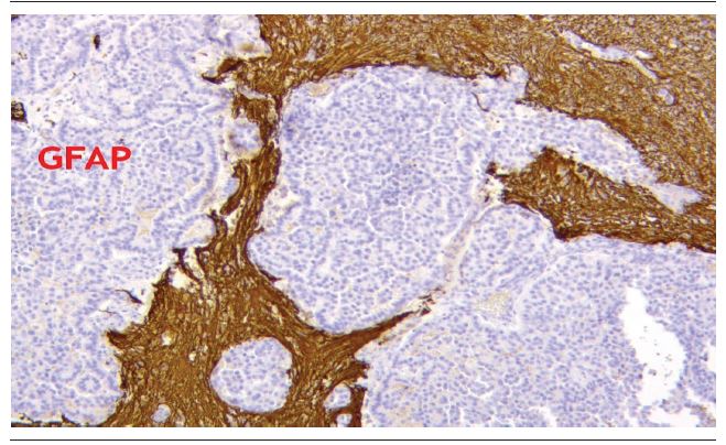 Immunohistochemistry demonstrating negative cells for GFAP GFAP: glial fibrillary acidic protein.