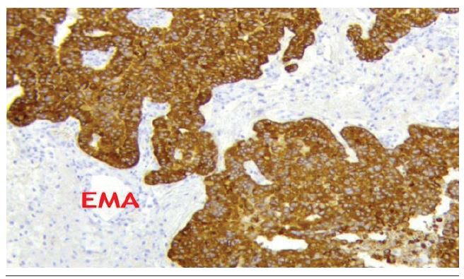 Immunohistochemistry demonstrating positive cells for EMA EMA: epithelial membrane antigen.