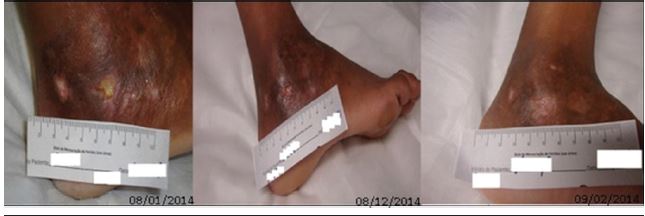 Evolution of malleolar ulcer in the left lower limb