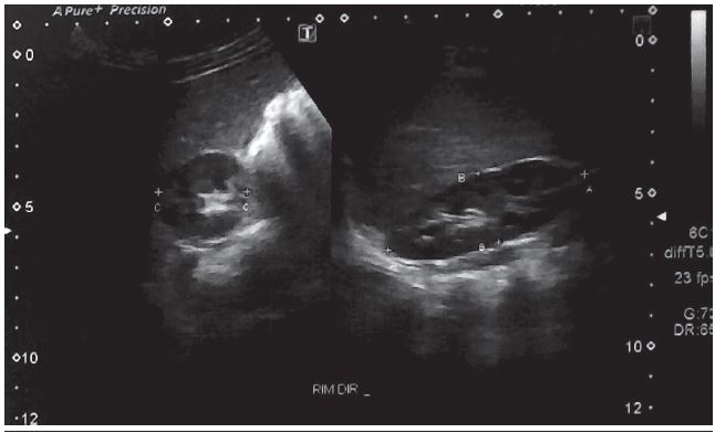 Dynamic US of the right kidney showing kidney size