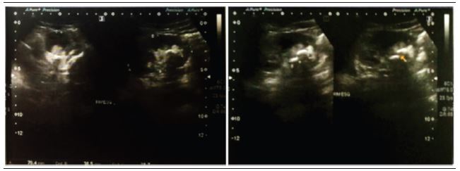 Dynamic US of left kidney showing kidney size and staghorn calculus
							(yellow arrow) size