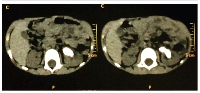 CT scan of abdomen and pelvis showing hyperintense mass in the left
							kidney