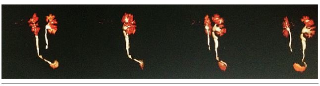 Dynamic renal scintigraphy showing upper urinary tract obstruction to
							the left