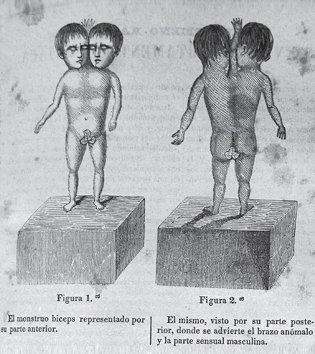 Conjoined twins from Oaxaca, published in “El MuseoMexicano”. A) El monstruo biceps representado por su parte anterior; B) El mismo, visto por su parte posterior, donde se advierte el brazo anómalo y la parte sensual masculina. 