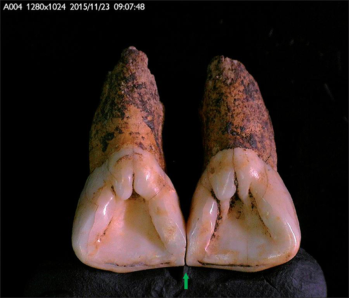 Compatibility between FDI 11 and 21: color of the enamel; size of teeth; morphological compatibility between antimeres; degree of tooth wear, and matching interproximal facets (arrow). Vertical tooth wear affected the mesial accessory ridge of both teeth. Photo: Claudia Cunha, 2016.