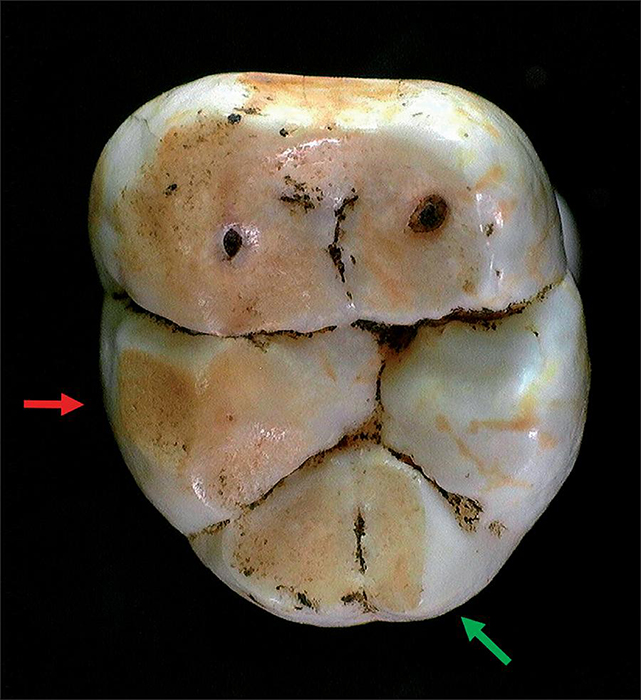 Occlusal and buccal tooth wear on the left 1st lower molar (FDI 36). Non dietary wear is also visible on the buccal aspect of cusps 1 and 3. Darker stains affecting different areas of enamel and patches of exposed dentine on cusp 1 and 2 are probably chemical contamination of mineral components in the anthropogenic dark sediment of the site. Photo: Claudia Cunha, 2016.