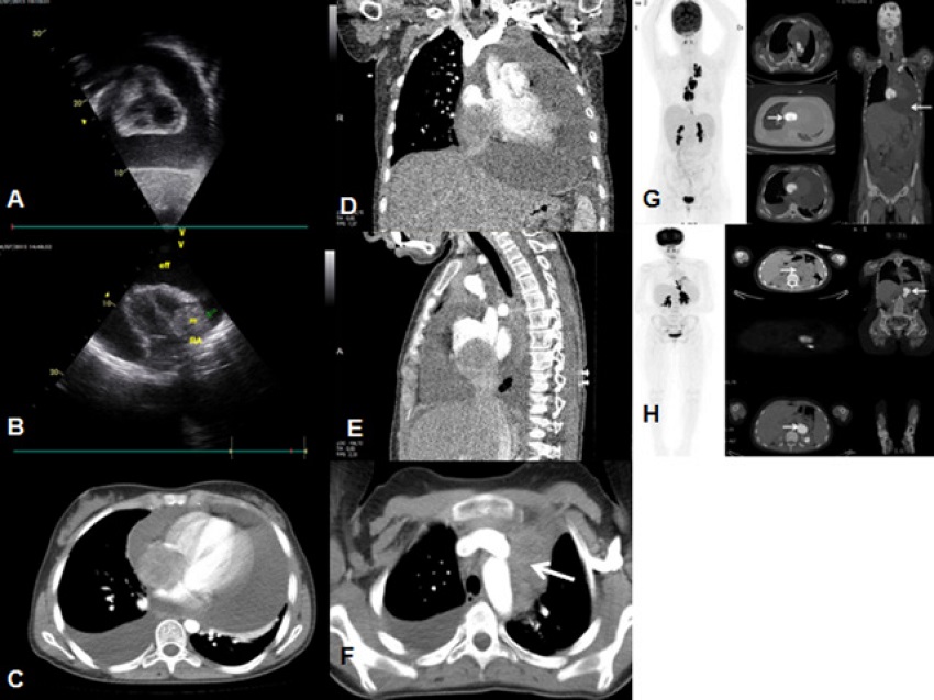 A) Pericardial effusion in transthoracic echocardiography. B)
							Hyperechogenic mass arising from the right atrium and invading the right
							ventricle on transthoracic echocardiography in four-chamber view. C)
							Axial thoracic computed tomography (CT). D) Coronal thoracic CT. E)
							Sagittal thoracic CT; soft tissue lesion (5 cm in size) filling the
							right atrial lumen and invading the right ventricle and, partially, the
							suprahepatic segment; pericardial and pleural effusion. F) Soft tissue
							lesion in left upper mediastinum (white arrow). G)
							(18)F-fluorodeoxyglucose (FDG) positron emission tomography/computed
							tomography (PET/CT) images demonstrate hypermetabolic mass (SUVmax:
							14.29) in the right atrium, bilateral pleural and pericardial effusion,
							and mediastinal metastatic lymphadenopathy (SUVmax: 15.07). H) FDG
							PET/CT images demonstrate hypermetabolic mass (SUVmax: 15) in the medial
							left kidney.