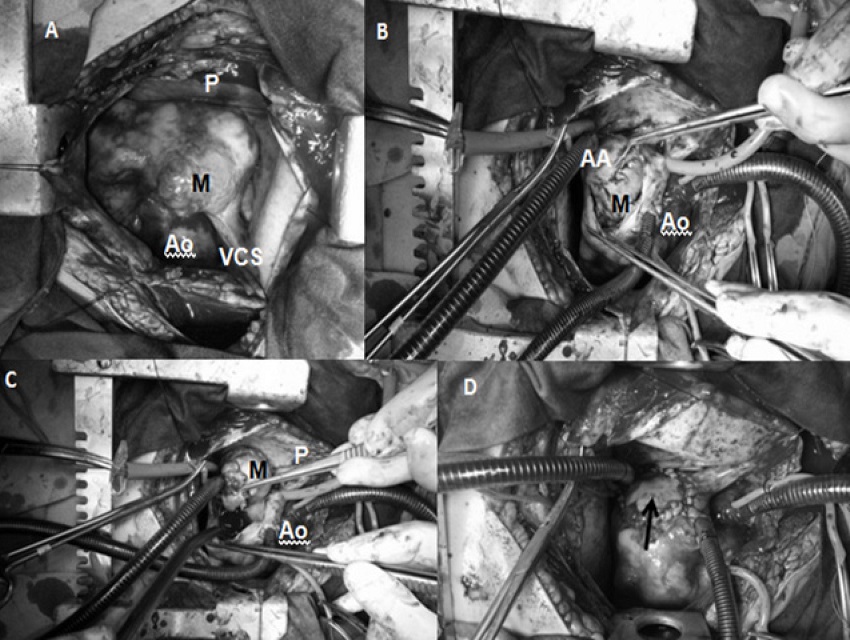 A) Mass (M) before right atriotomy. B) Mass infiltrating atrial
								appendage (AA). C) Removal of the mass. D) The defect was repaired
								by pericardial tissue.