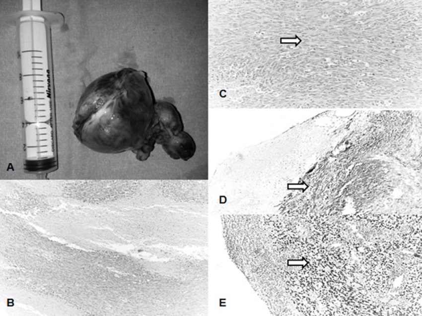 A) Gross pathological picture of the tumor. B) Cellularity and
								necrosis of the angiosarcoma (HE, x100). C) Angiosarcoma cells
								round, oval, or spindle shaped (arrow) (HE, x200). D) Tumor cells
								(arrow) were immunohistochemistry cytoplasmic stained by cluster of
								differentiation 34 (CD34, x200). E) Tumor cells (arrow) show nuclear
								positive immunohistochemical staining with friend leukemia
								integration-1 (FLI-1) (CD34, x100).