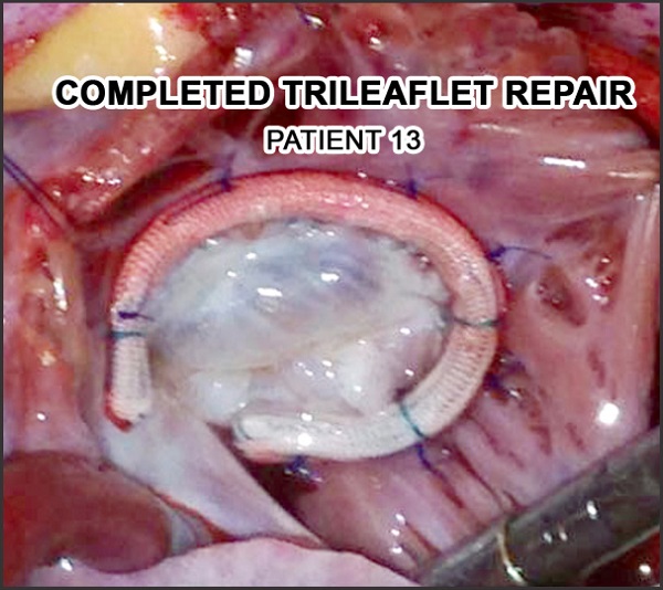 Intraoperative photograph of a completed Ebstein's repair showing
								neoannulus supported by a 3D ring and competent trileaflet
								repair.